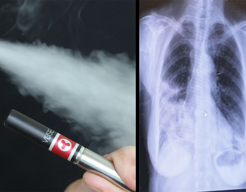 Medical Professional Links 'Popcorn Lung' Disease to Vaping