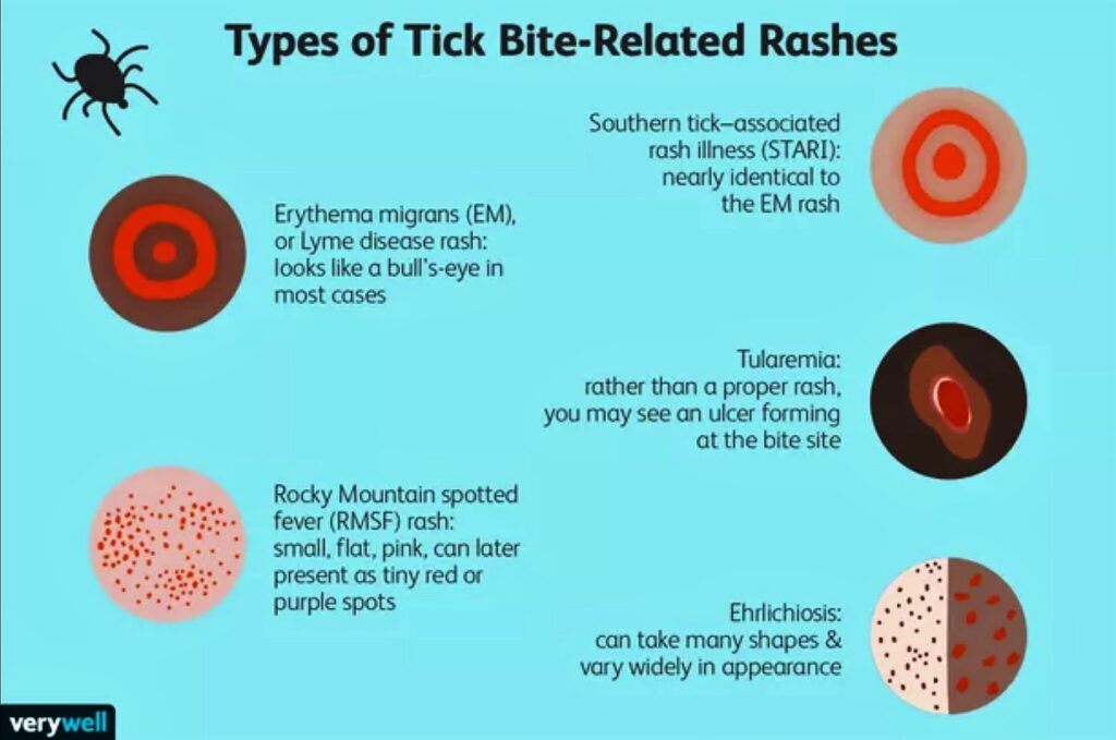 photo of types of tick rashes from verywellhealthDOTcom